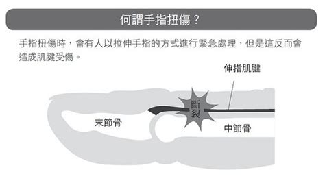 中指受傷|手指扭傷：症狀、病因及如何治療